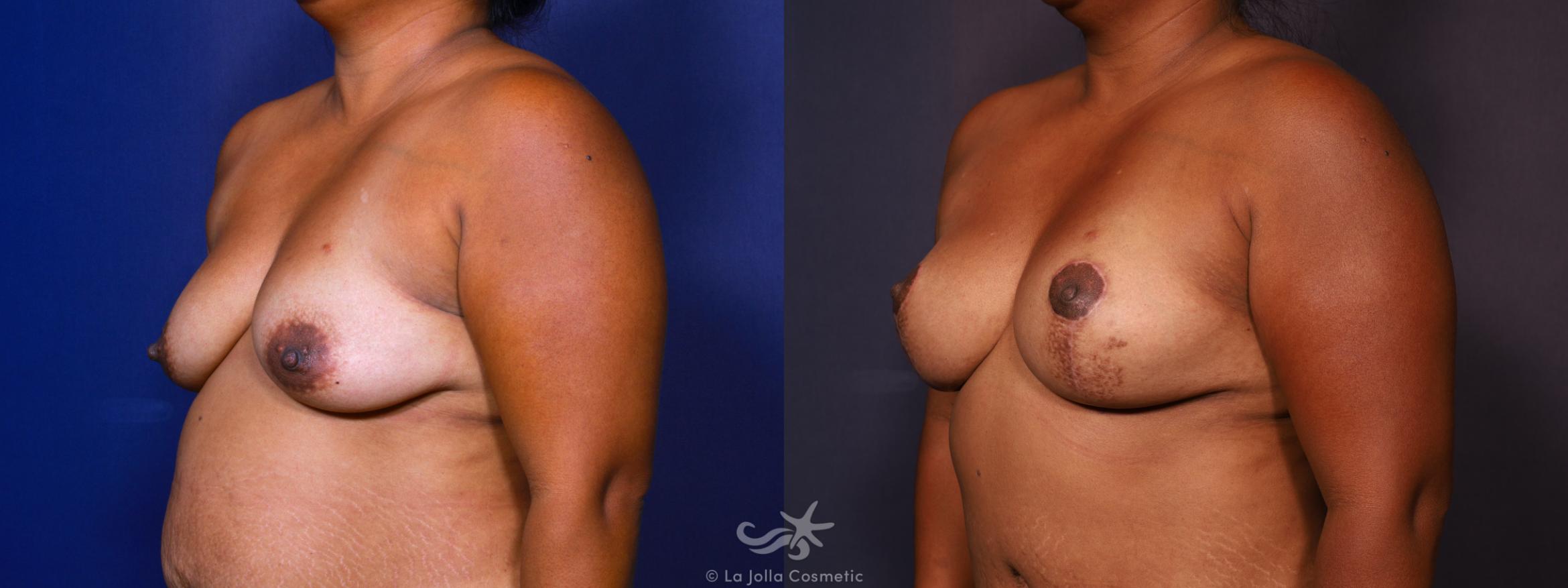 Before & After Breast Augmentation with Lift Result 666 Left Oblique View in San Diego, CA