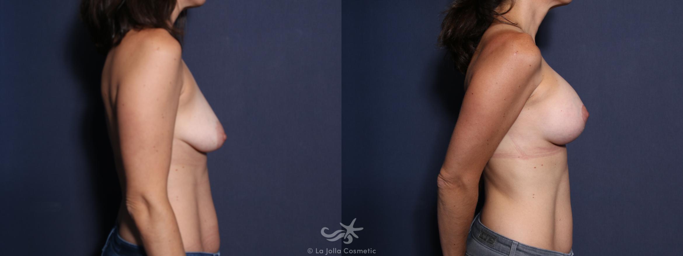 Before & After Breast Augmentation with Lift Result 77 Right Side View in San Diego, CA