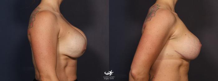 Form and Face - Custom sports bra cleavage created by Dr Norris with 375CC  round implants! 👌 This patient had a breast lift with implants to  reposition and reshape her chest in