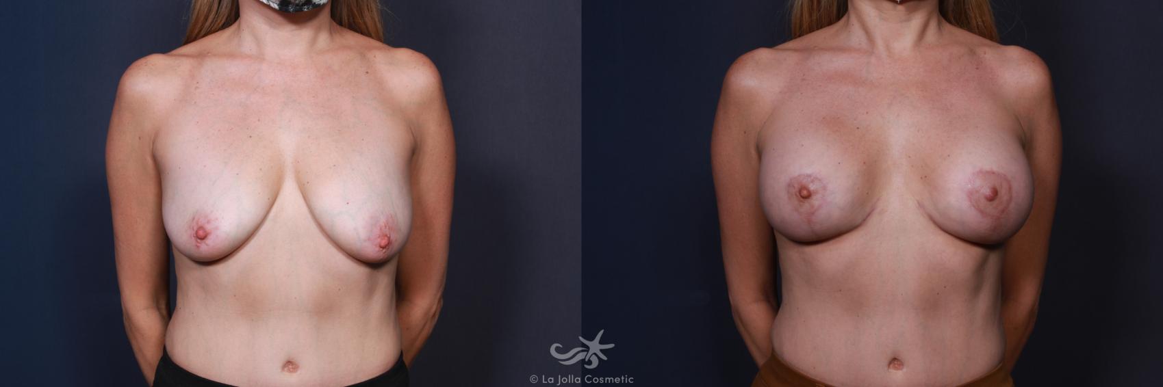 Before & After Breast Augmentation with Lift Result 8 Front View in San Diego, CA