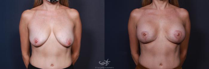 Before & After Breast Lift Result 8 Front View in San Diego, Carlsbad, CA