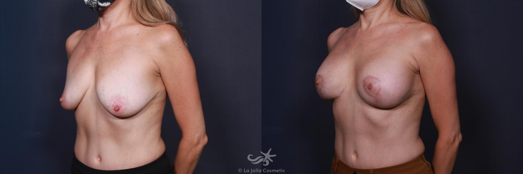 Before & After Breast Augmentation with Lift Result 8 Left Oblique View in San Diego, CA