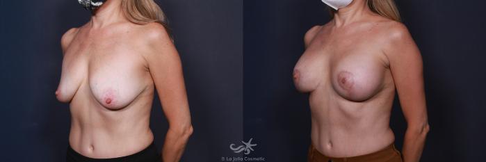 Before & After Breast Augmentation with Lift Result 8 Left Oblique View in San Diego, Carlsbad, CA