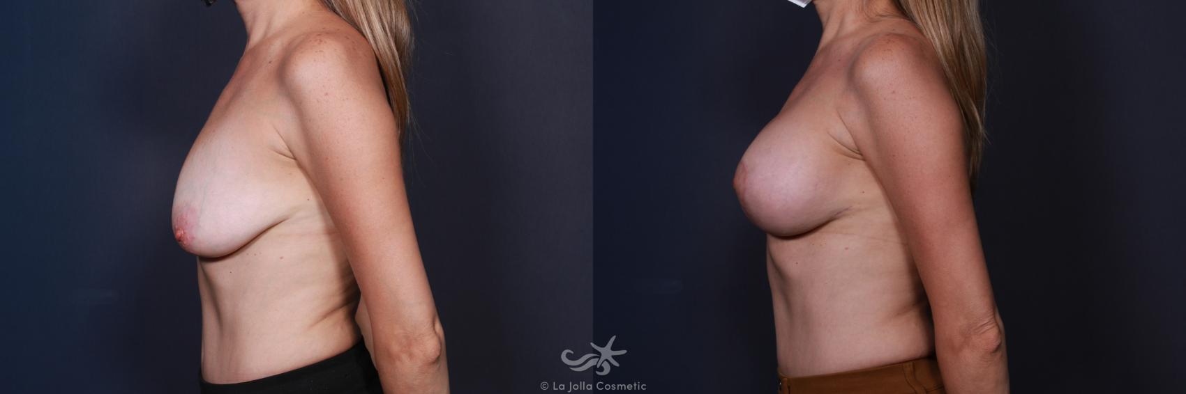 Before & After Breast Augmentation with Lift Result 8 Left Side View in San Diego, CA