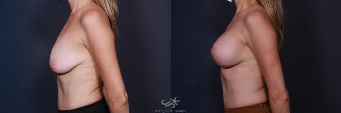 Before & After Breast Augmentation with Lift Result 8 Left Side View in San Diego, Carlsbad, CA