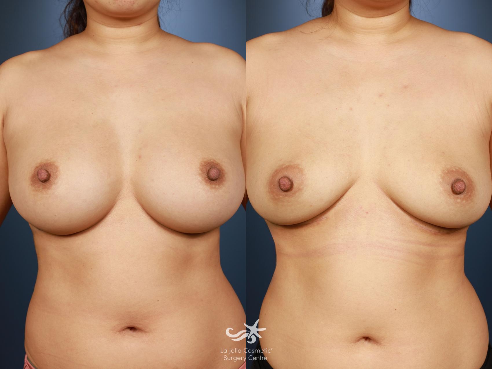 Before & After Breast Implant Removal Result 1320 Front View in San Diego, CA