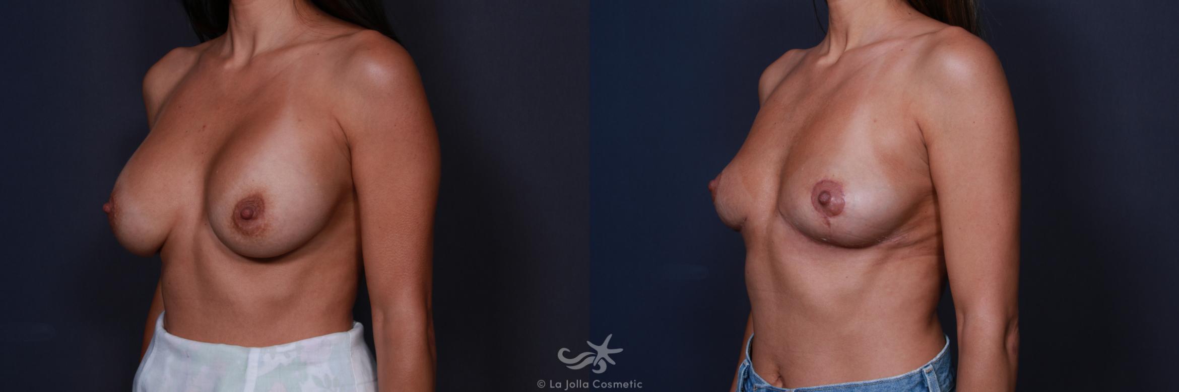 Before & After Breast Implant Removal Result 200 Left Oblique View in San Diego, CA