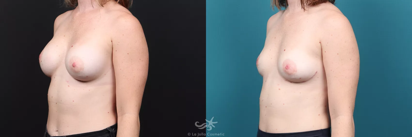 Before & After Breast Implant Removal Result 37 Left Oblique View in San Diego, CA