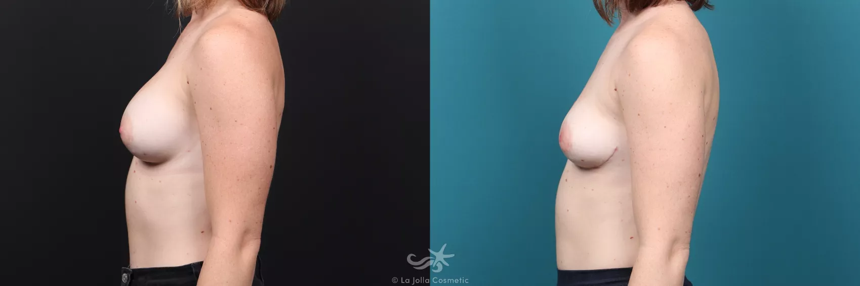 Before & After Breast Implant Removal Result 37 Left Side View in San Diego, CA