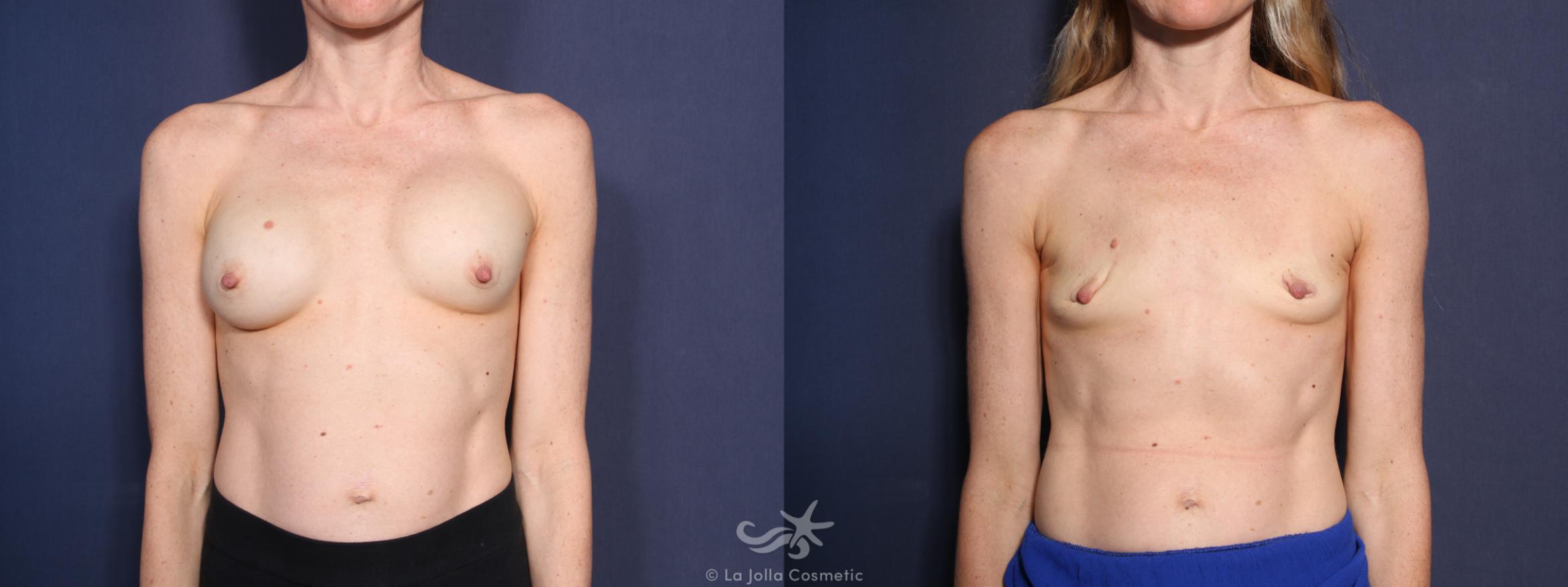 Before & After Breast Implant Removal Result 40 Front View in San Diego, CA