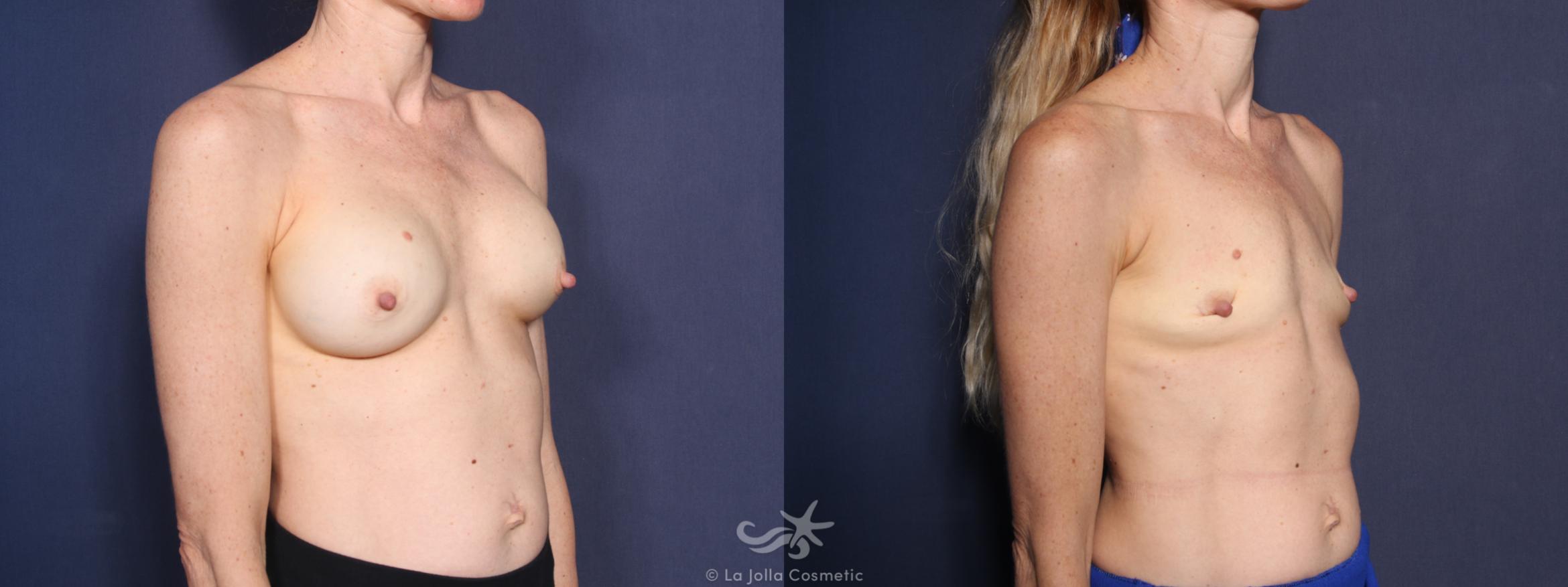 Before & After Breast Implant Removal Result 40 Right Oblique View in San Diego, CA