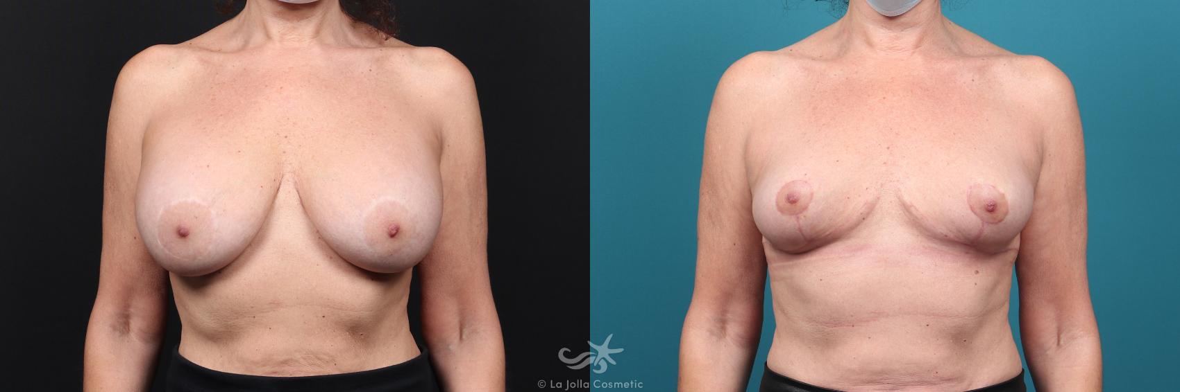 Before & After Breast Implant Removal Result 46 Front View in San Diego, CA