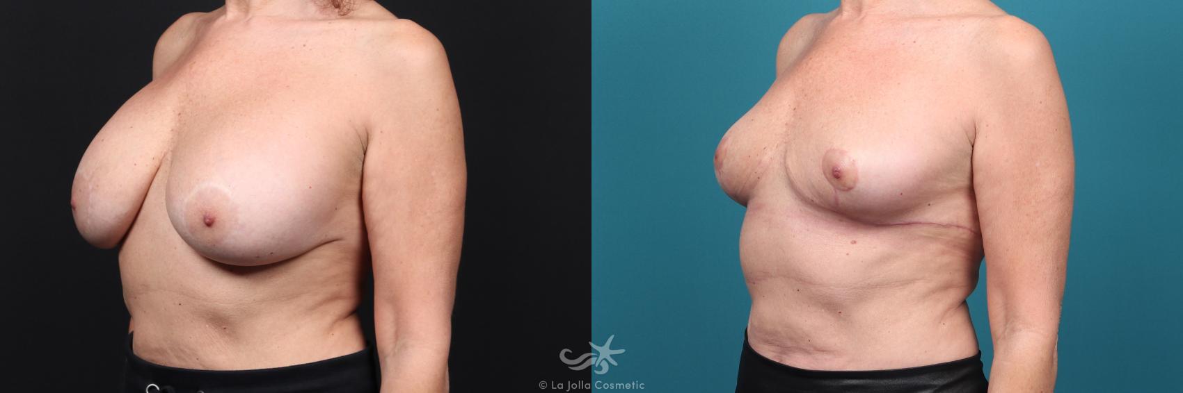 Before & After Breast Implant Removal Result 46 Left Oblique View in San Diego, CA
