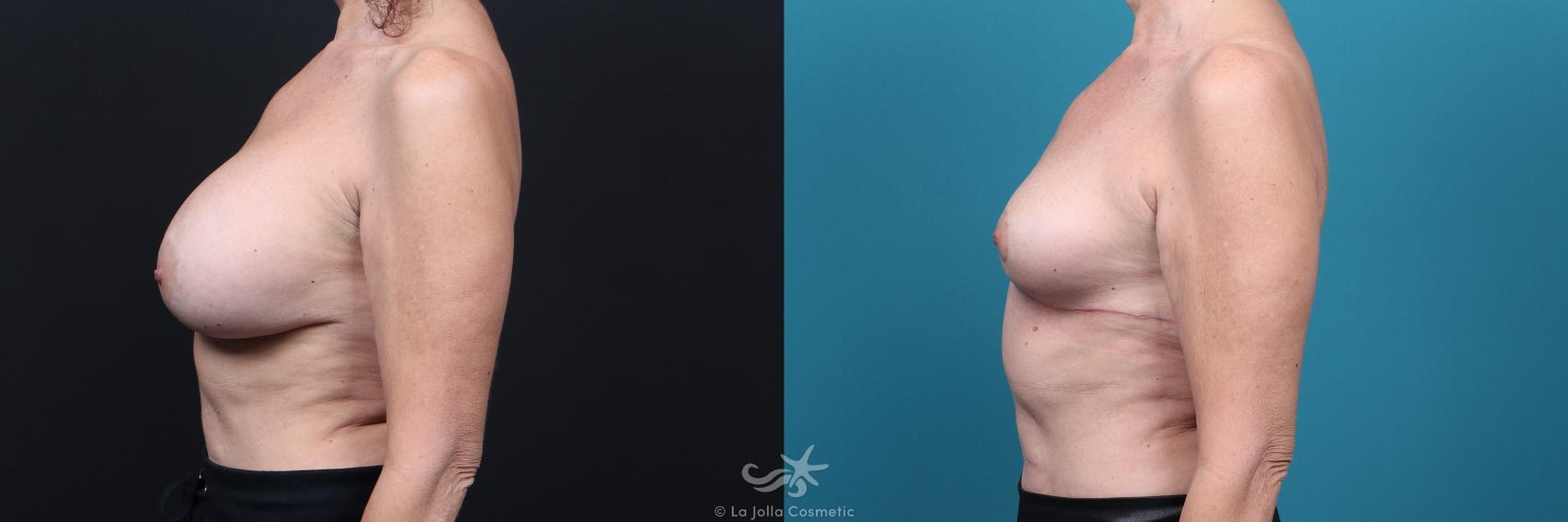 Before & After Breast Implant Removal Result 46 Left Side View in San Diego, CA