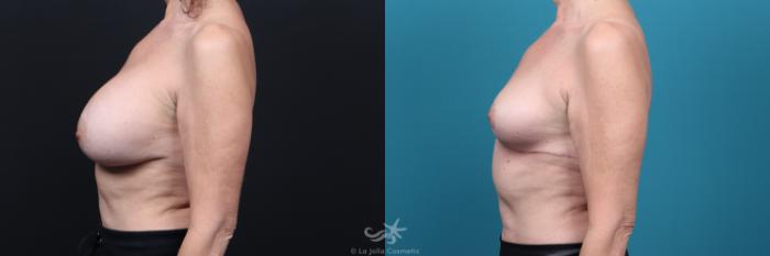 Before & After Breast Implant Removal Result 46 Left Side View in San Diego, Carlsbad, CA