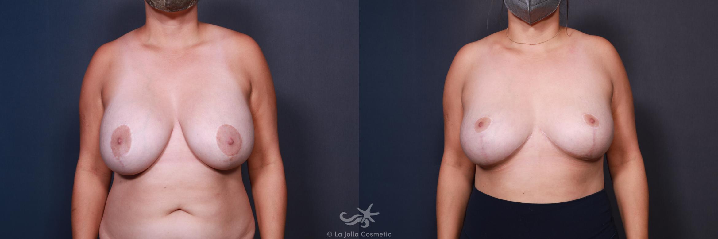 Before & After Breast Implant Removal Result 563 Front View in San Diego, CA