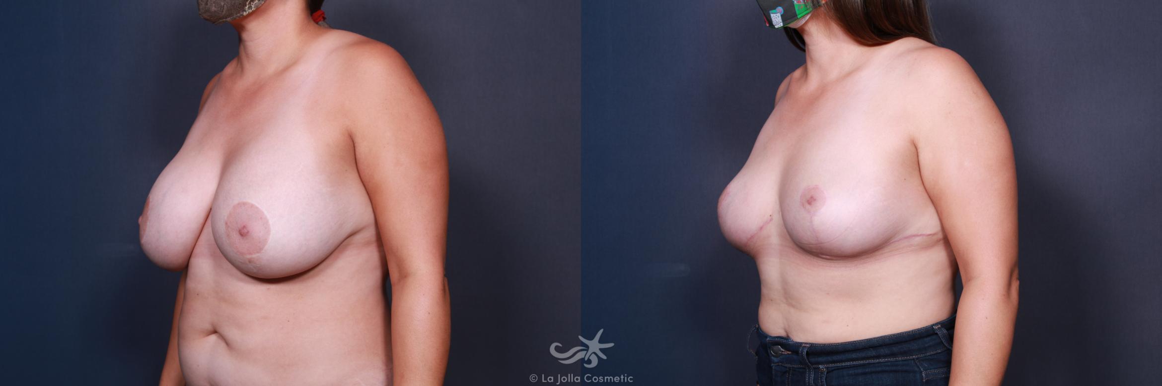 Before & After Breast Implant Removal Result 563 Left Oblique View in San Diego, CA