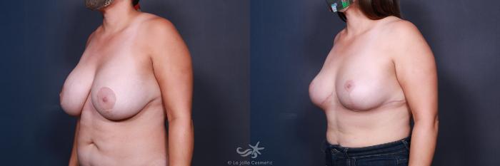Before & After Breast Implant Removal Result 563 Left Oblique View in San Diego, Carlsbad, CA