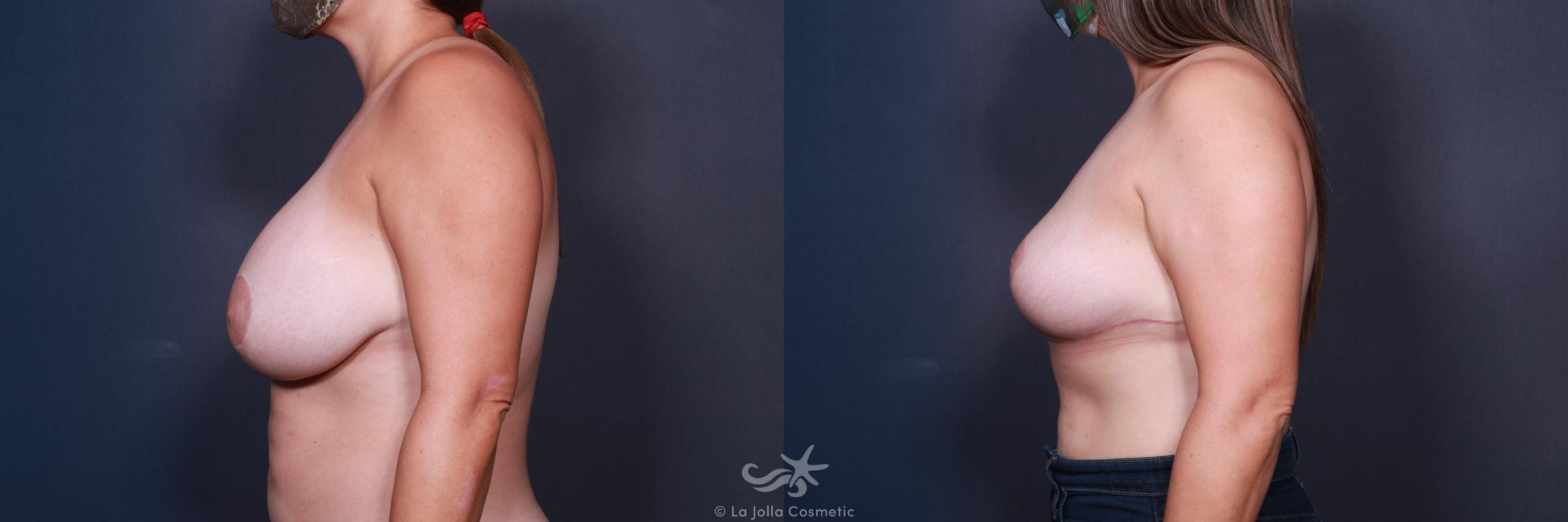 Before & After Breast Implant Removal Result 563 Left Side View in San Diego, CA