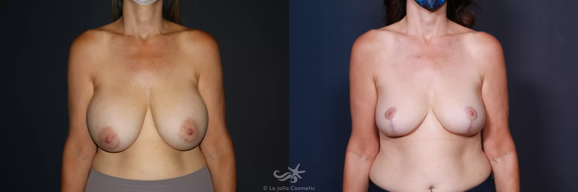 Before & After Breast Implant Removal Result 564 Front View in San Diego, CA