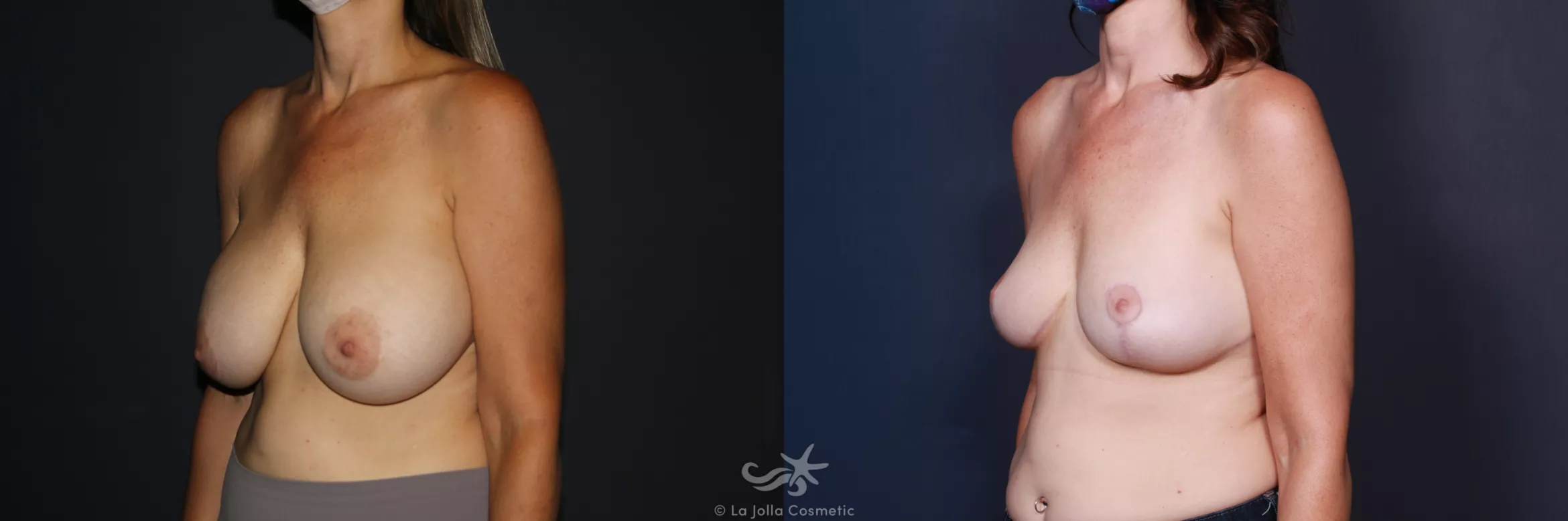 Before & After Breast Implant Removal Result 564 Left Oblique View in San Diego, CA