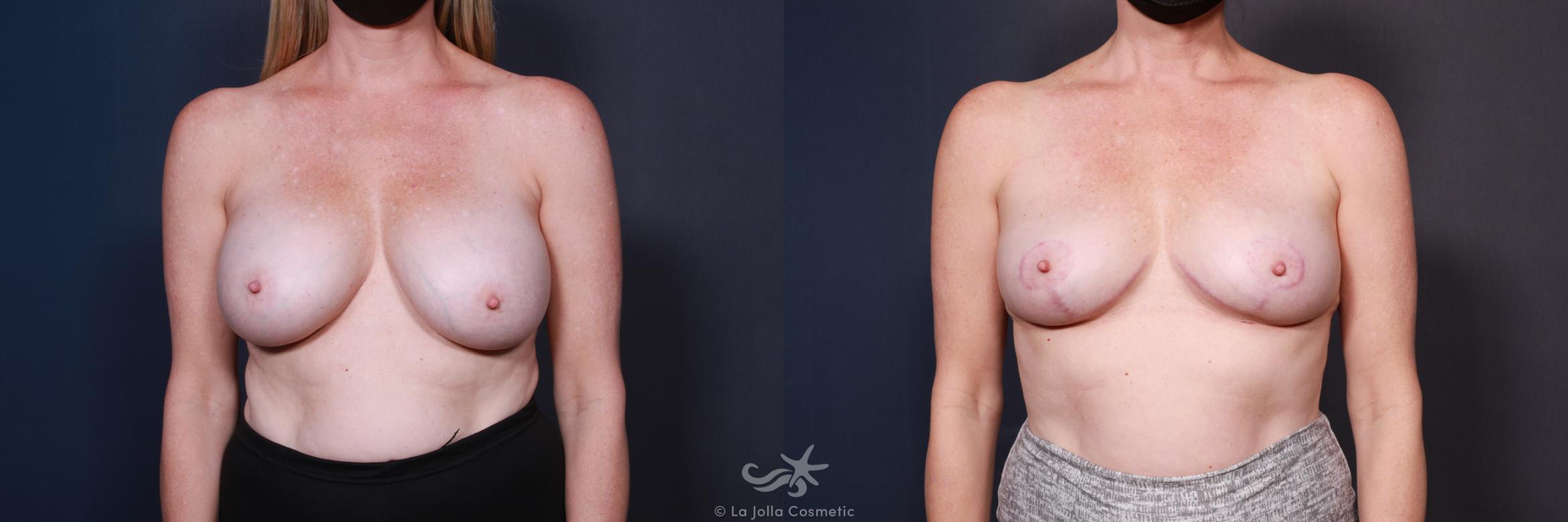 Before & After Breast Implant Removal Result 586 Front View in San Diego, CA