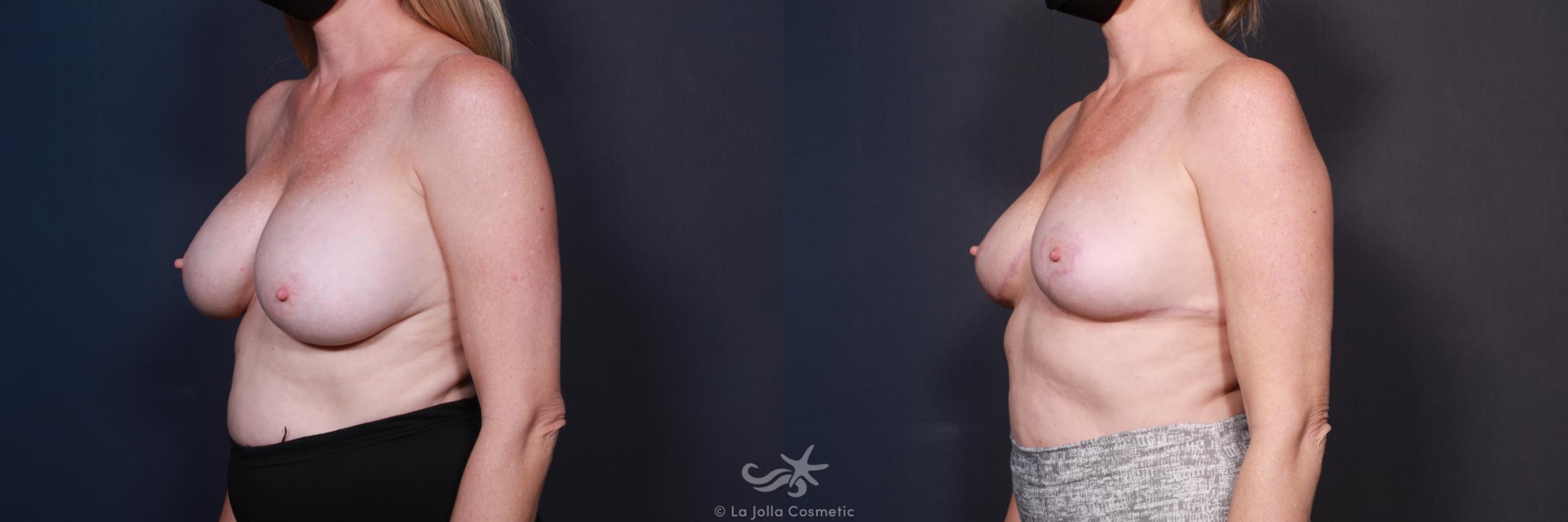 Before & After Breast Implant Removal Result 586 Left Oblique View in San Diego, CA