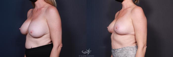 Before & After Breast Implant Removal Result 586 Left Oblique View in San Diego, Carlsbad, CA