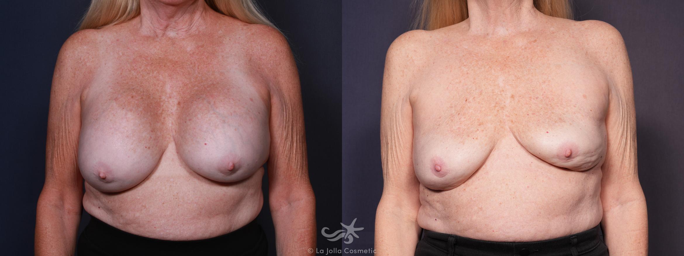 Before & After Breast Implant Removal Result 626 Front View in San Diego, CA