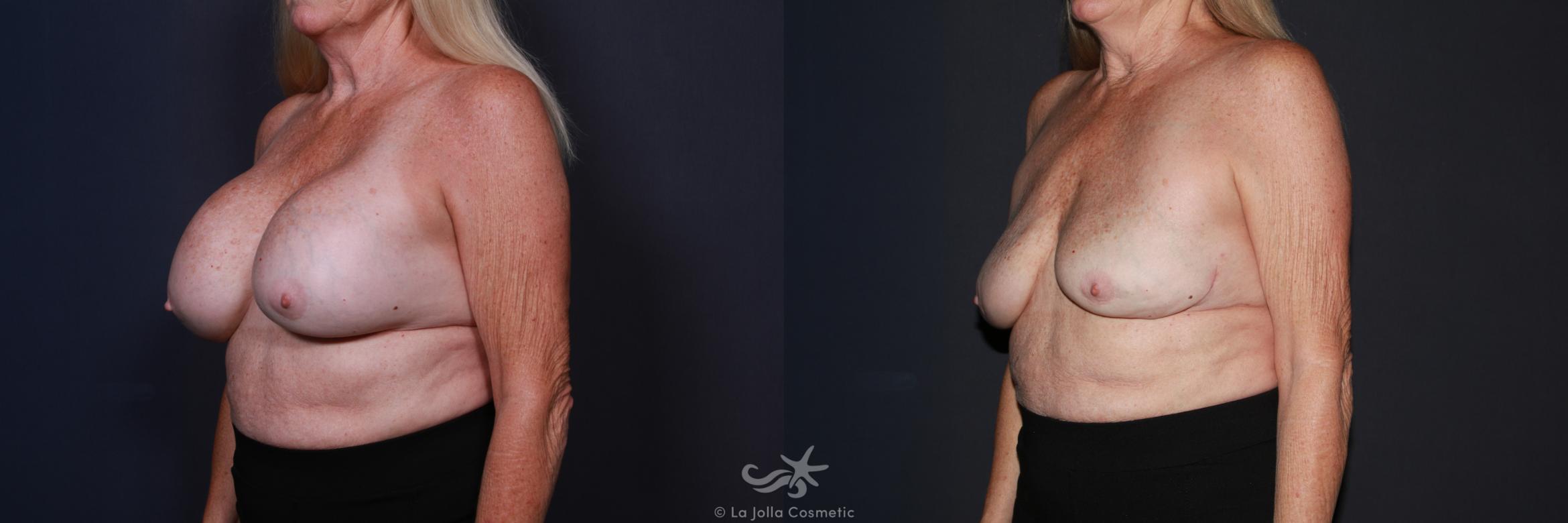 Before & After Breast Implant Removal Result 626 Left Oblique View in San Diego, CA
