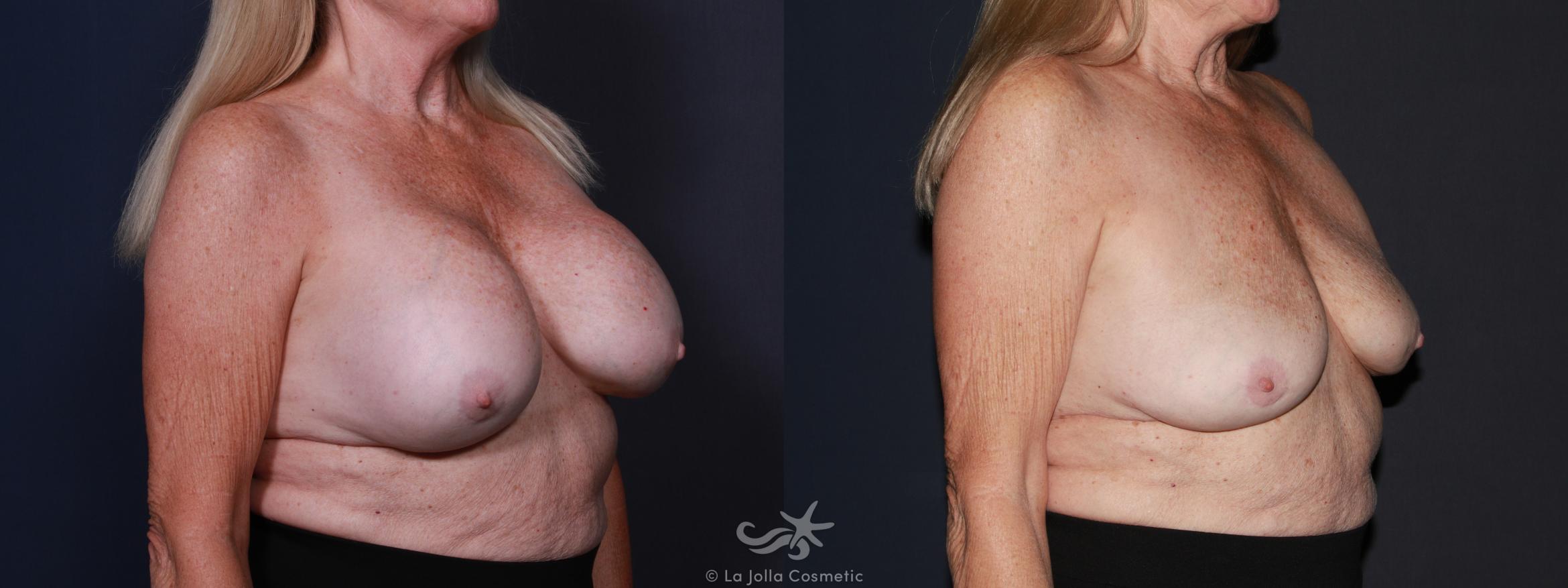 Before & After Breast Implant Removal Result 626 Right Oblique View in San Diego, CA