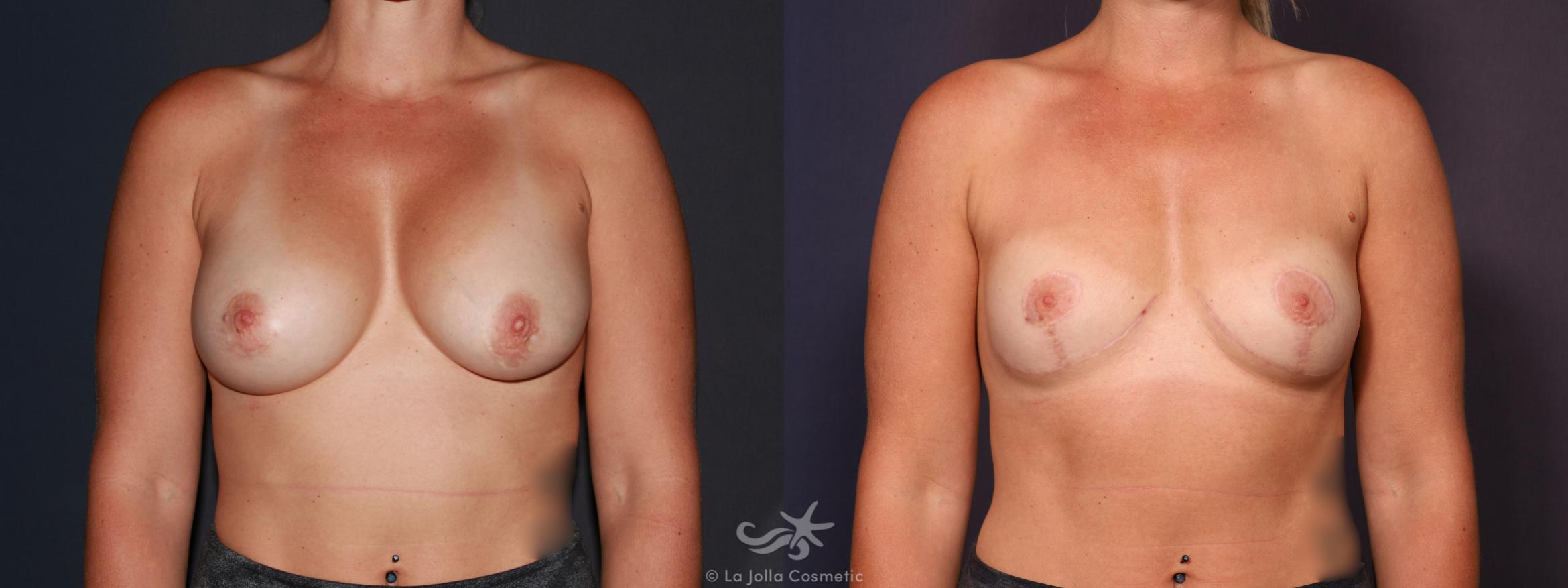 Before & After Breast Implant Removal Result 648 Front View in San Diego, CA