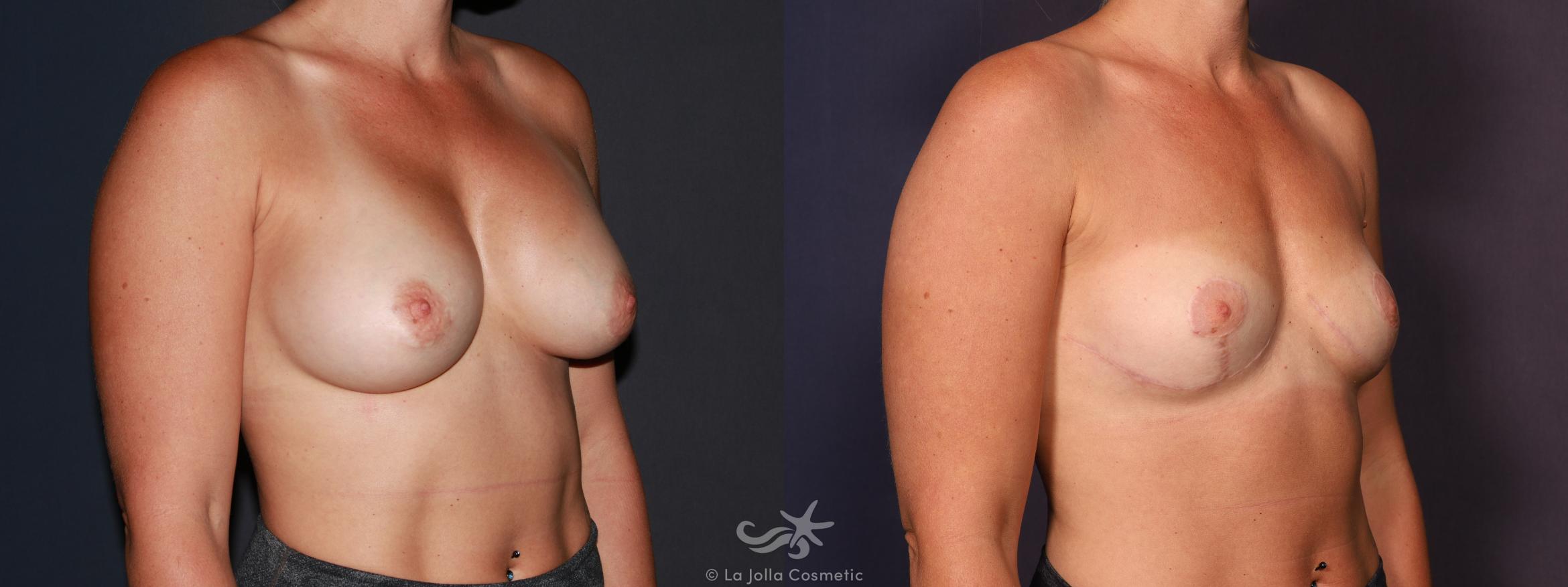 Before & After Breast Implant Removal Result 648 Right Oblique View in San Diego, CA