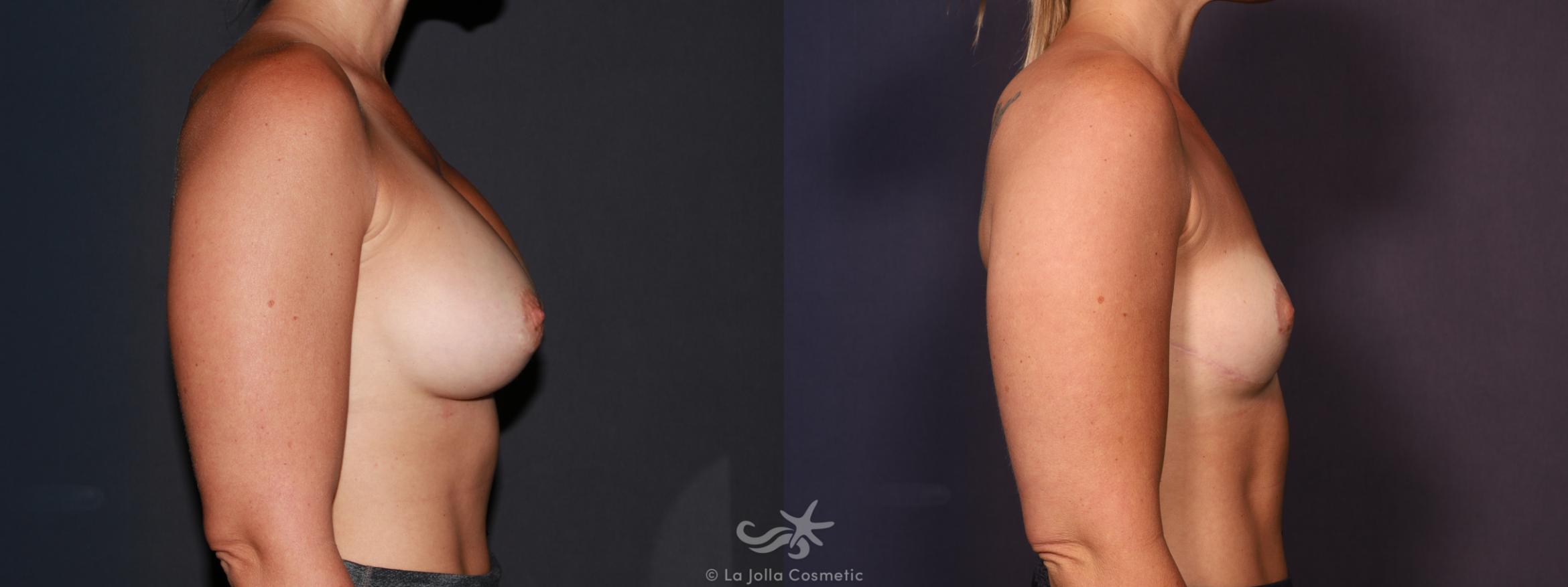 Before & After Breast Implant Removal Result 648 Right Side View in San Diego, CA