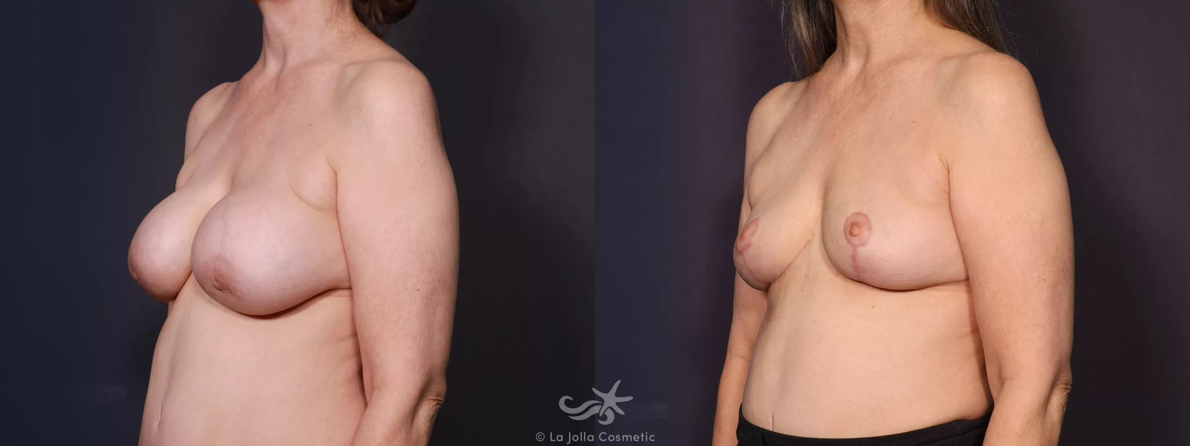 Before & After Breast Implant Removal Result 674 Left Oblique View in San Diego, CA