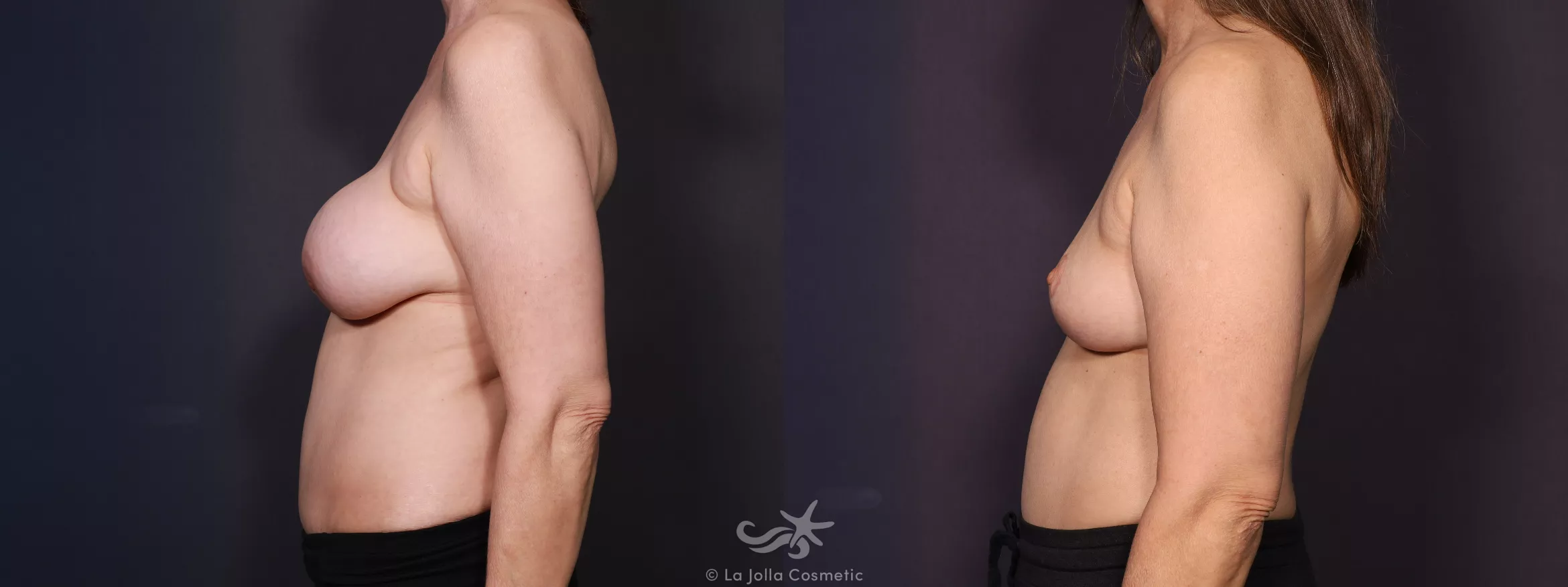 Before & After Breast Implant Removal Result 674 Left Side View in San Diego, CA