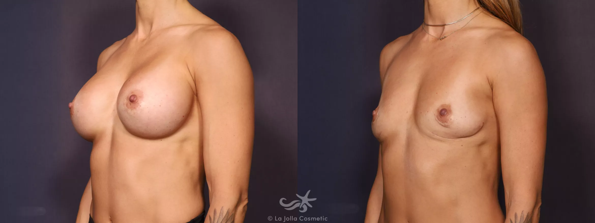 Before & After Breast Implant Removal Result 728 Left Oblique View in San Diego, CA