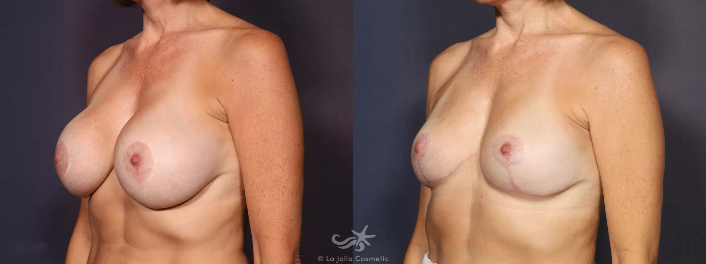 Before & After Breast Implant Removal Result 738 Left Oblique View in San Diego, CA