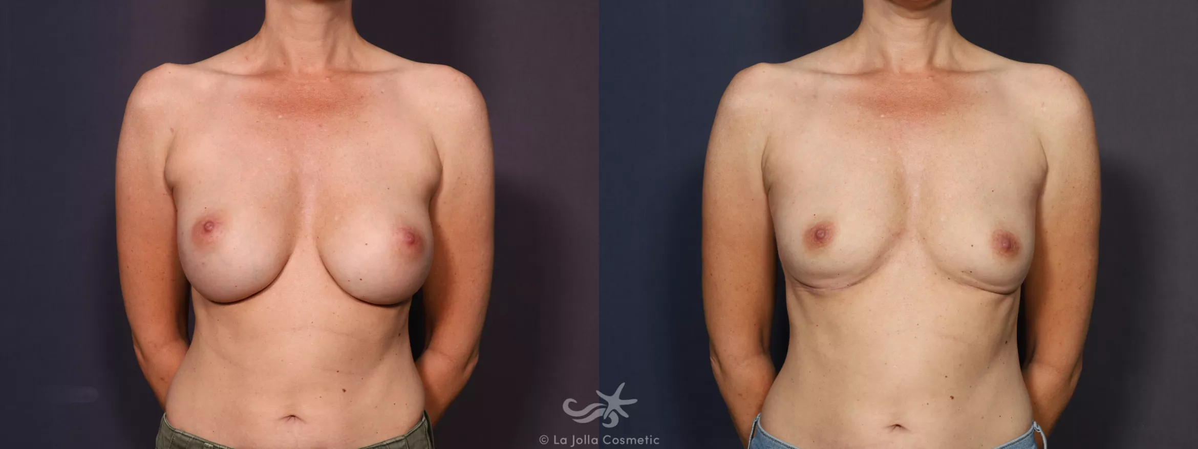 Before & After Breast Implant Removal Result 742 Front View in San Diego, CA