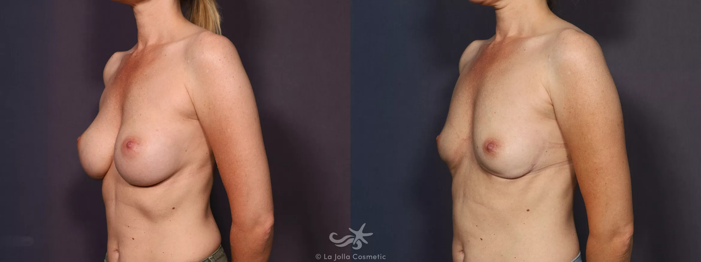 Before & After Breast Implant Removal Result 742 Left Oblique View in San Diego, CA