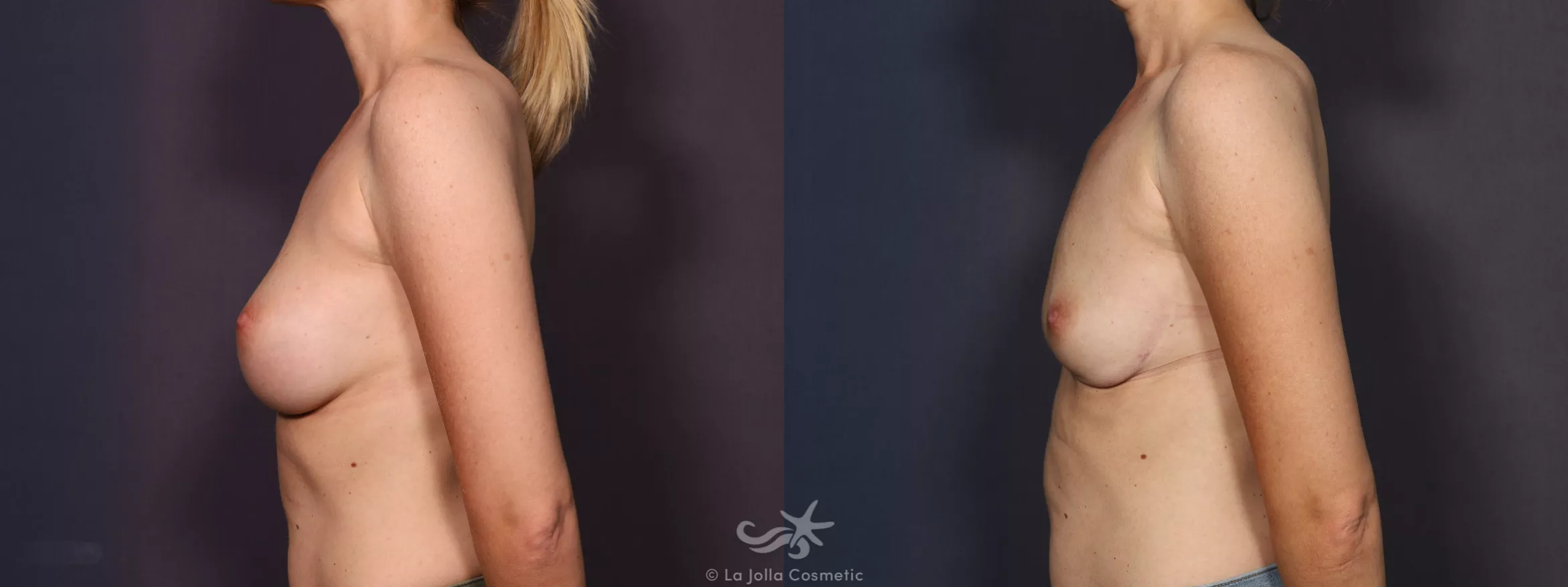 Before & After Breast Implant Removal Result 742 Left Side View in San Diego, CA