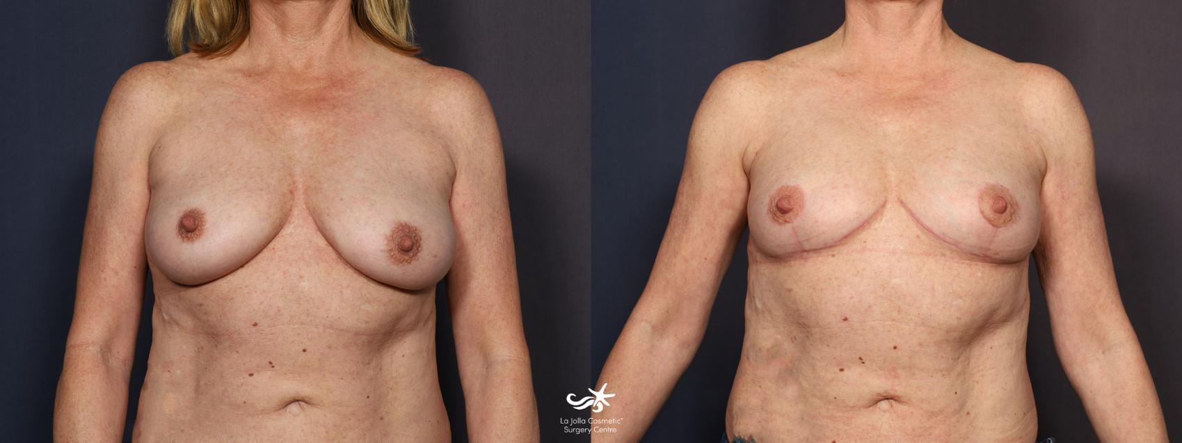Before & After Breast Implant Removal Result 781 Front View in San Diego, CA