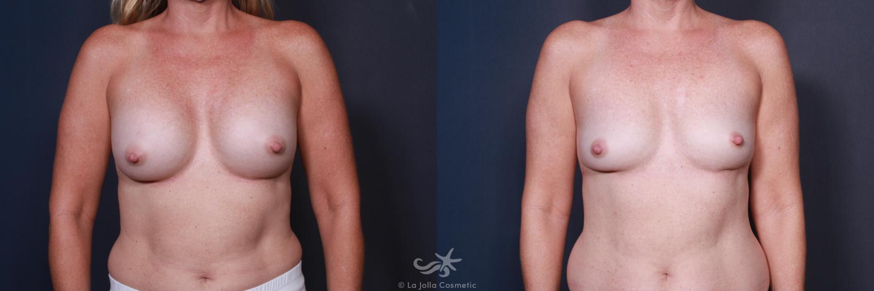 Before & After Breast Implant Removal Result 79 Front View in San Diego, CA