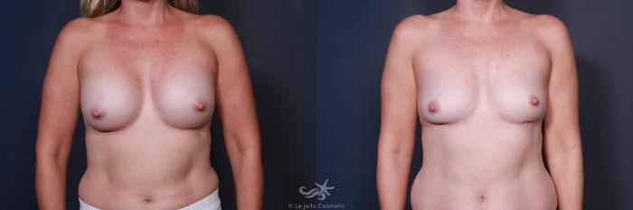 Before & After Breast Implant Removal Result 79 Front View in San Diego, Carlsbad, CA