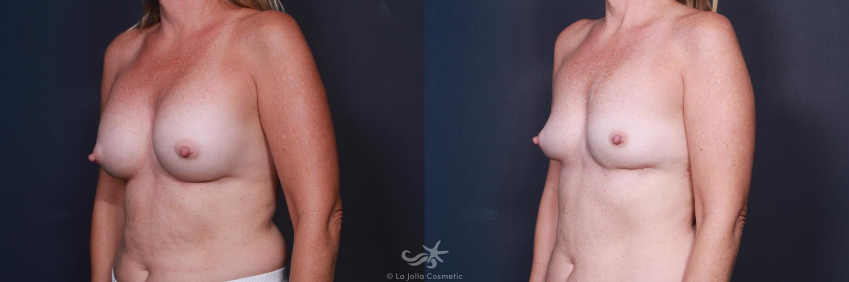 Before & After Breast Implant Removal Result 79 Left Oblique View in San Diego, CA