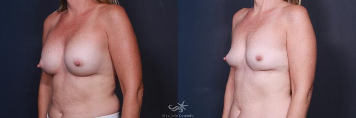 Before & After Breast Implant Removal Result 79 Left Oblique View in San Diego, Carlsbad, CA