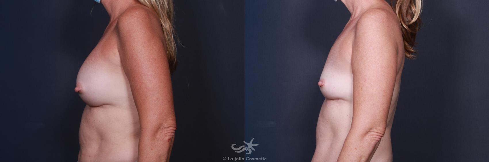 Before & After Breast Implant Removal Result 79 Left Side View in San Diego, CA