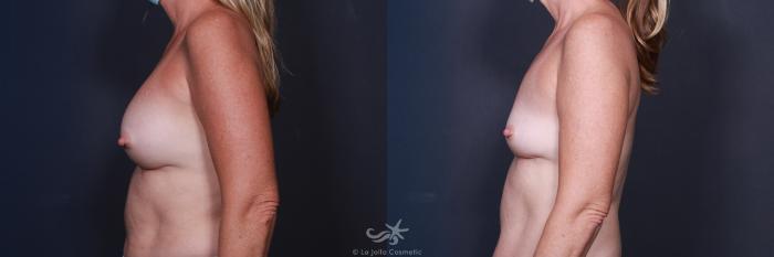 Before & After Breast Implant Removal Result 79 Left Side View in San Diego, Carlsbad, CA