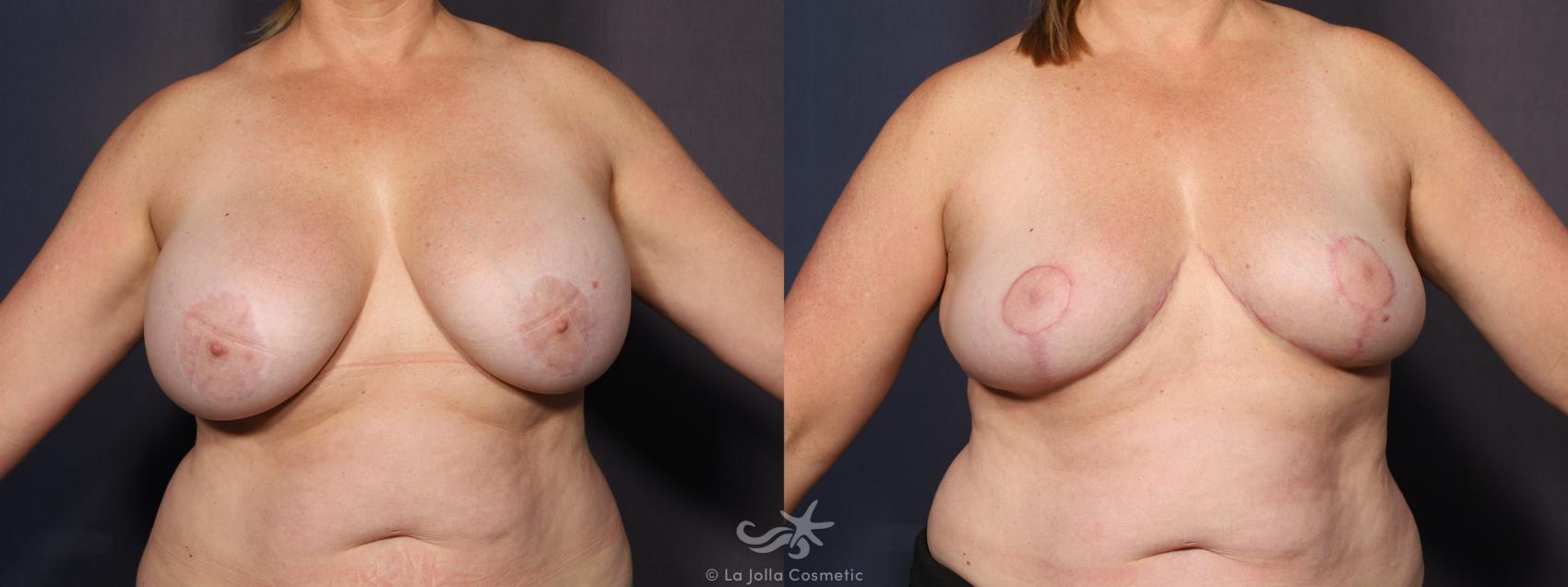 Before & After Breast Implant Removal Result 983 Front View in San Diego, Carlsbad, CA