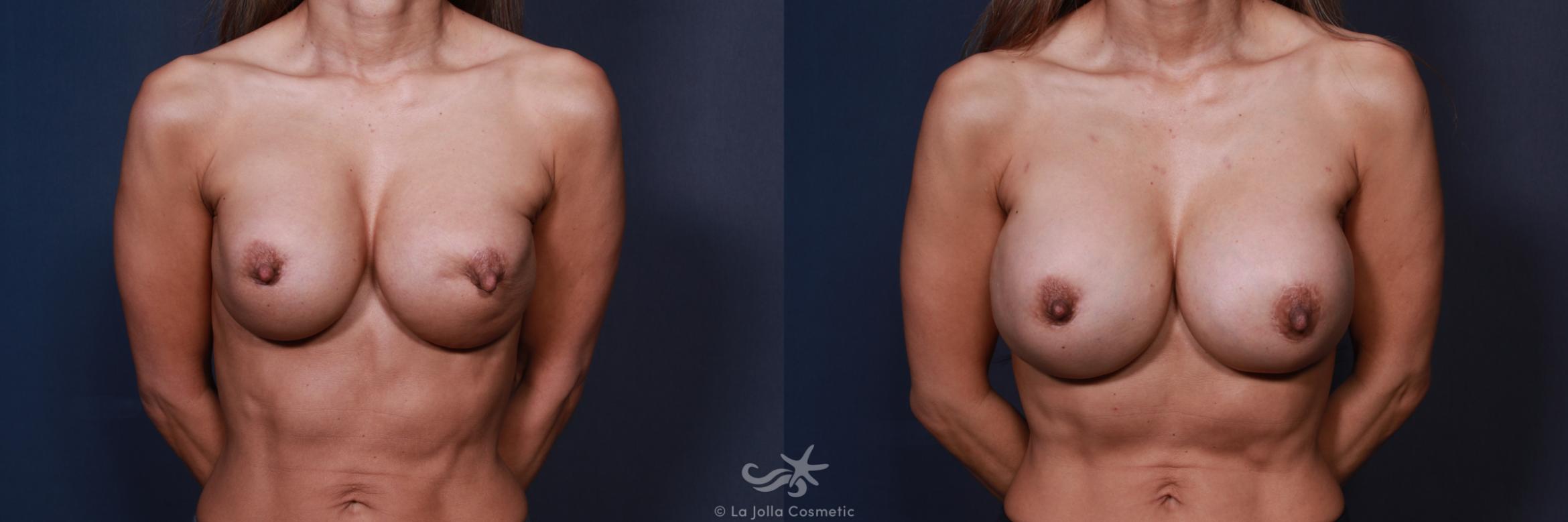 Before & After Breast Implant Replacement Result 214 Front View in San Diego, CA